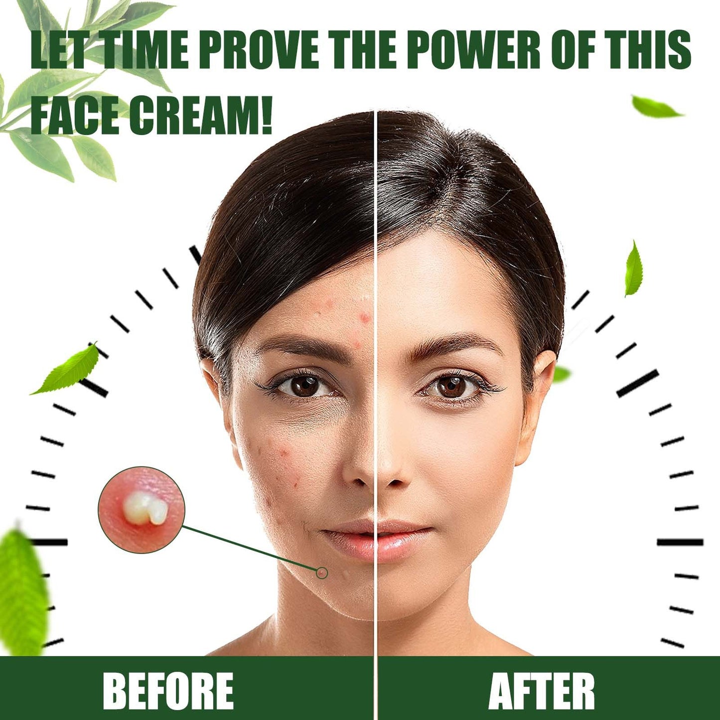 Anti-Akne Gesichts Creme 30g